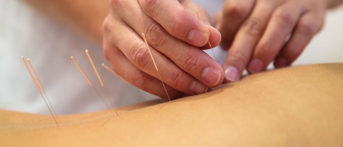 Acuputcture