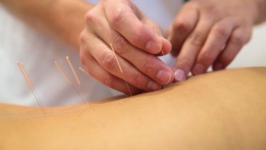 Acuputcture