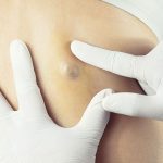 Sebaceous Cyst Removal