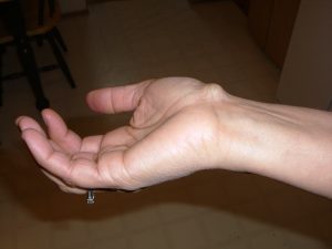 Ganglion cyst on a wrist